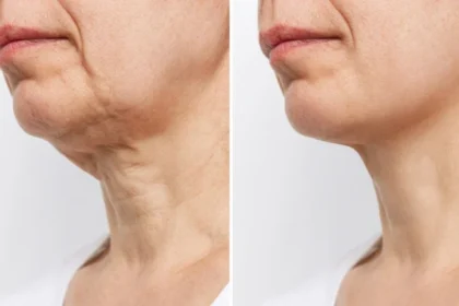 Cellulogia: A Holistic Path to Smooth, Firm Skin