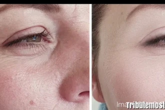 Microneedling Before and After